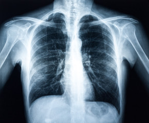 X-Ray Chest (2 Views)
