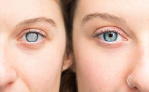 Cataract Surgery